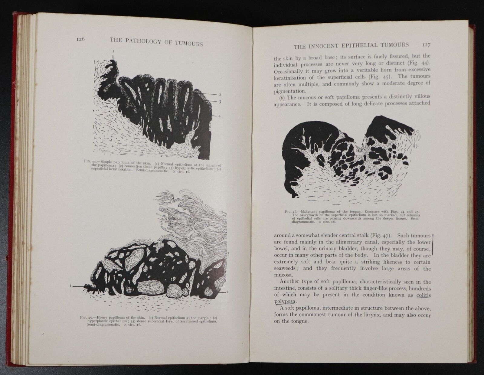 1925 The Pathology Of Tumours by E.H. Kettle Antique Medical Research Book
